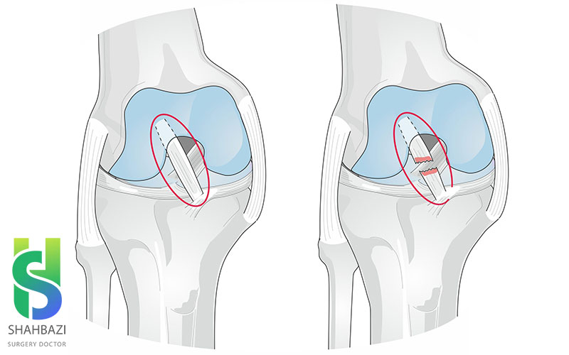 بهترین جراح پارگی رباط صلیبی