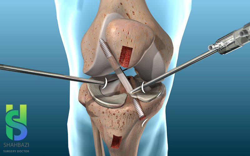 بهترین جراح پارگی رباط صلیبی
