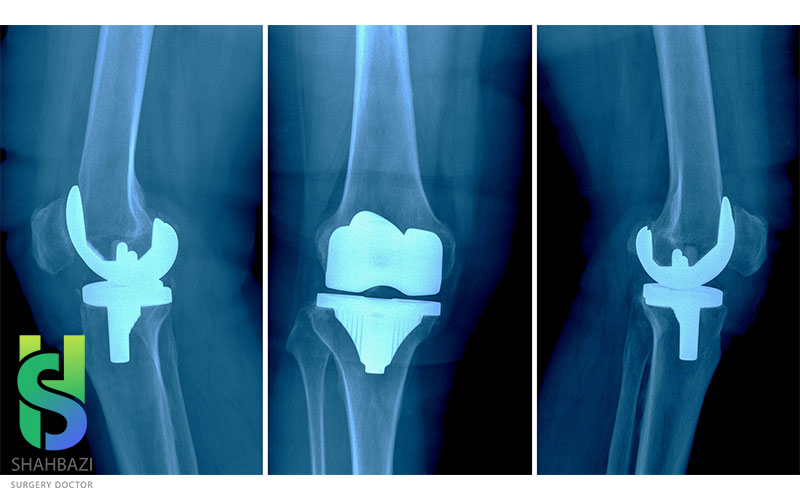 دکتر تعویض مفصل زانو در شریعتی